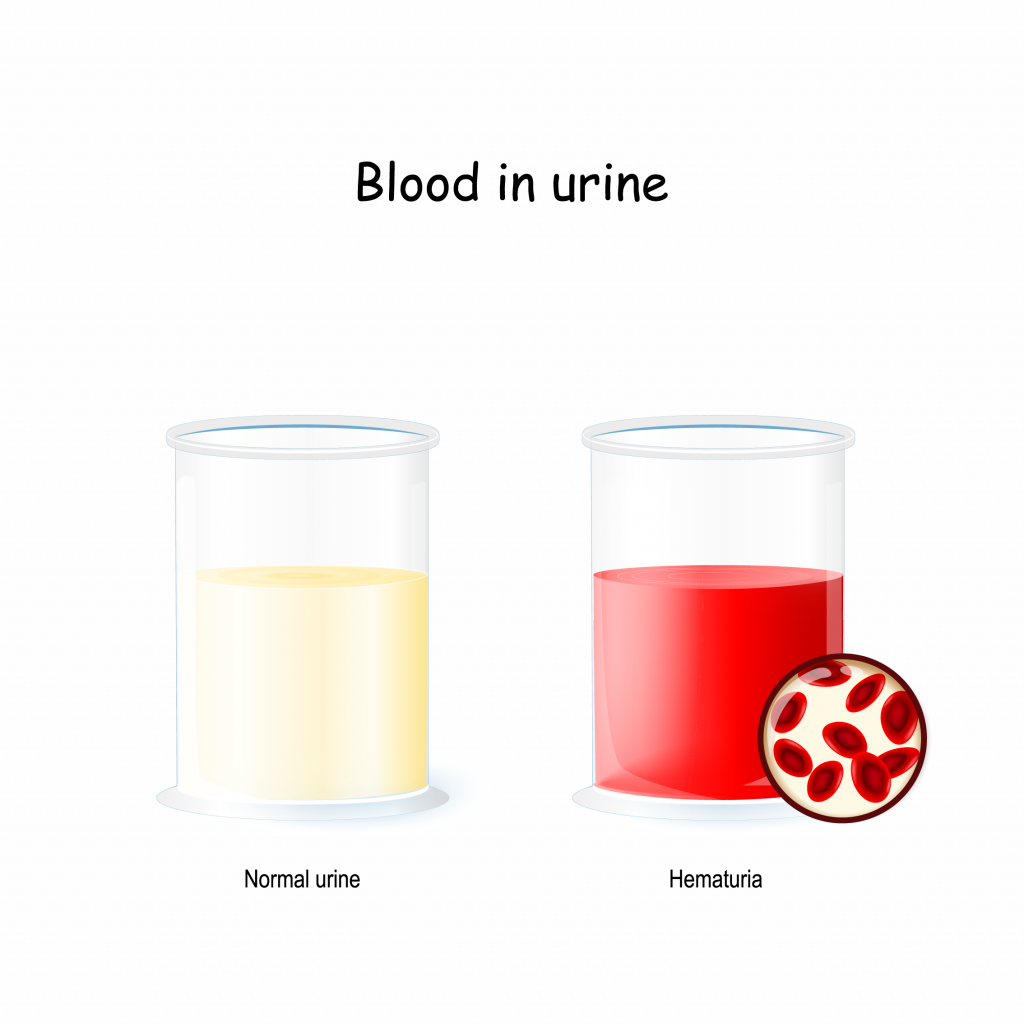 Hematuria (Blood in Urine) Feifer Urology