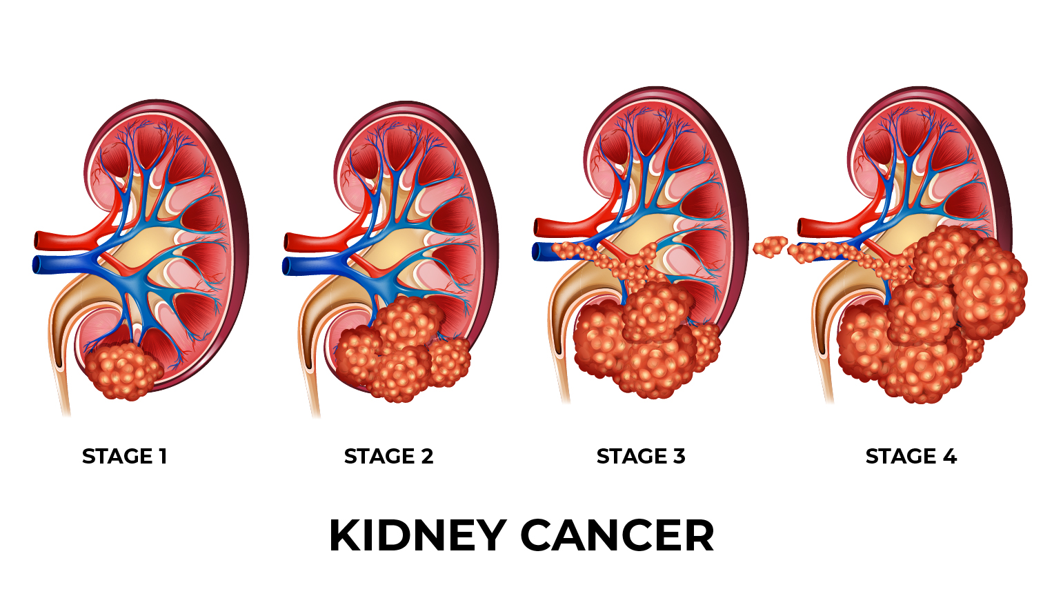  Kidney Cancer Renal Cancer 