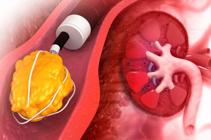Surgery for Stones in Urinary Tract Feifer Urology